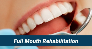 Read more about the article Full mouth rehabilitation with Dental implants in missing area