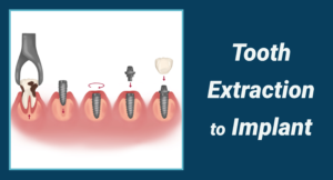 Read more about the article Journey of patient from Tooth extraction to Implant