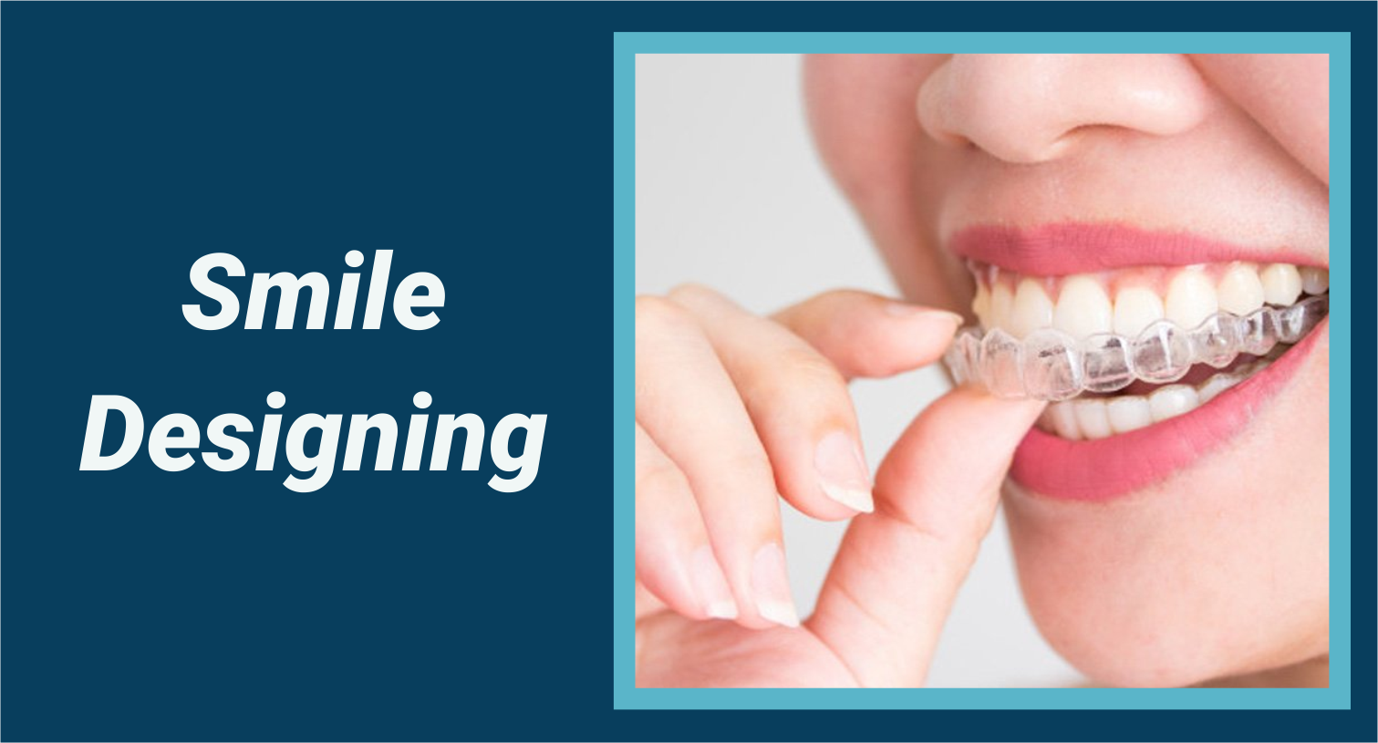 Read more about the article Smile Designing by Braces & Zirconia Premium Crowns